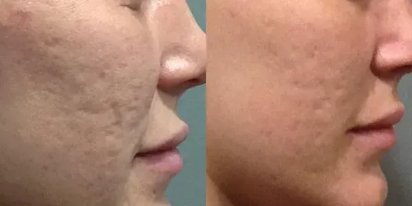 Före och efter microneedling
