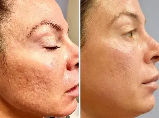 Resultat av microneedling